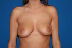 before Breast Augmentation