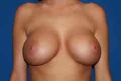 after Breast Augmentation