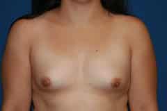 before Breast Augmentation