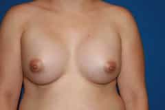 Breast Augmentation after