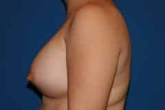 after Breast Augmentation