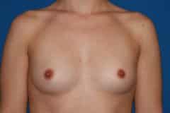 before Breast Augmentation
