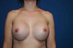 after Breast Augmentation