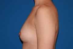 before Breast Augmentation