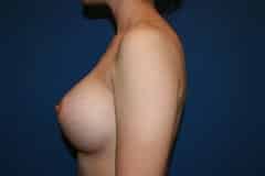 after Breast Augmentation