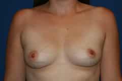 before Breast Augmentation