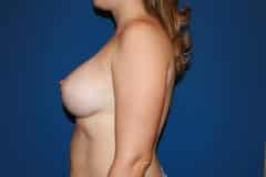 Breast Augmentation after