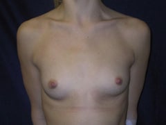 Breast Augmentation before