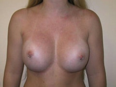 after Breast Augmentation