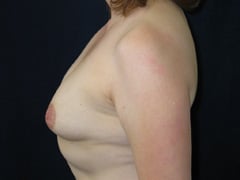Breast Augmentation Patient before
