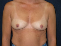 Breast Augmentation Patient before