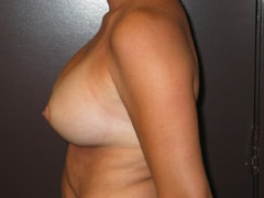 Breast Augmentation Patient after