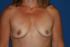 Breast Augmentation Patient before