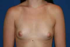 Breast Augmentation Patient