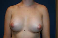 breast augmentation after