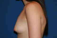 breast augmentation before