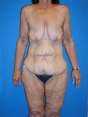 Extended Abdominoplasty / Circumferential Body Lift Patient 01 Before