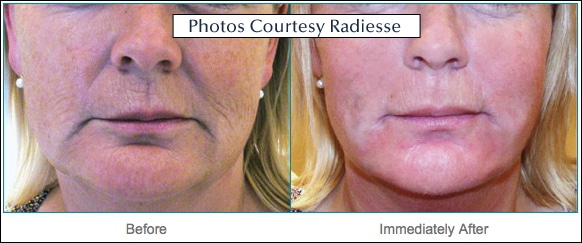 RADIESSE® Patient