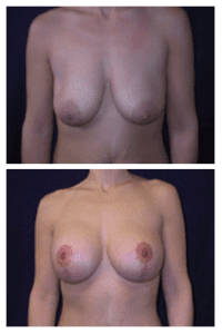 Andreasen Breast Augmentation Case