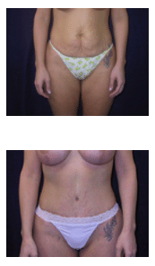 Andreasen Tummy Tuck case