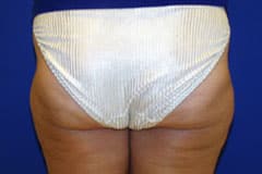 Liposuction in Orange county After image