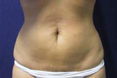 Liposuction in Orange county After image