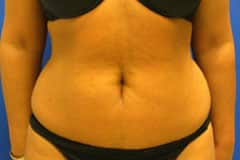 Liposuction in Orange county before image