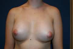 Breast Augmentation Patient 01 After