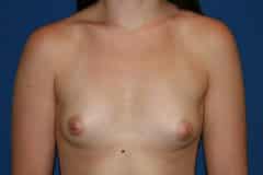 Breast Augmentation Patient 01 Before