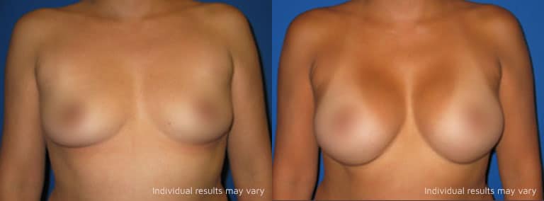 Breast Augmentation Patient