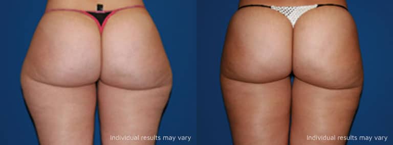 liposuction before and after