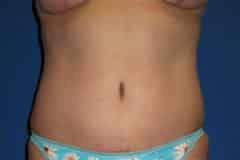 Tummy Tuck Patient 01 After
