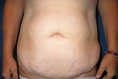 Tummy Tuck Patient 01 Before