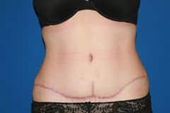 Tummy Tuck Patient After