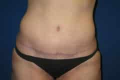 Tummy Tuck Patient 03 After