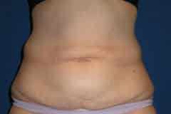 Tummy Tuck Patient 03 Before