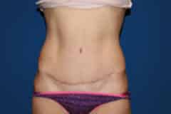 Tummy Tuck Patient 04 After