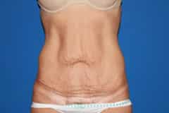 Tummy Tuck Patient 04 Before