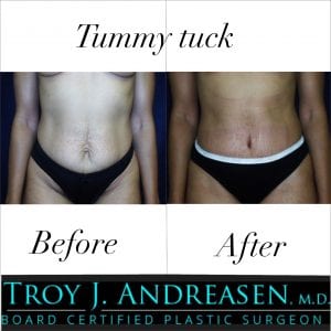 Andreasen Tummy Tuck Patient