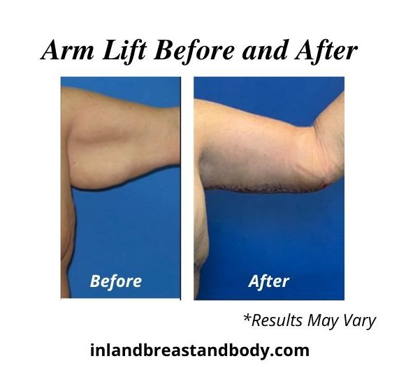 Actual arm lift patient results