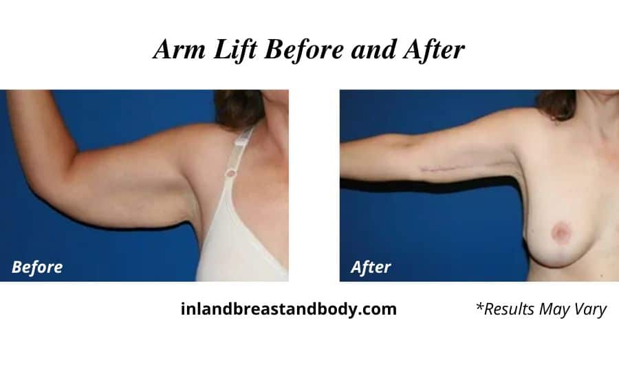 A woman before and after her arm lift.