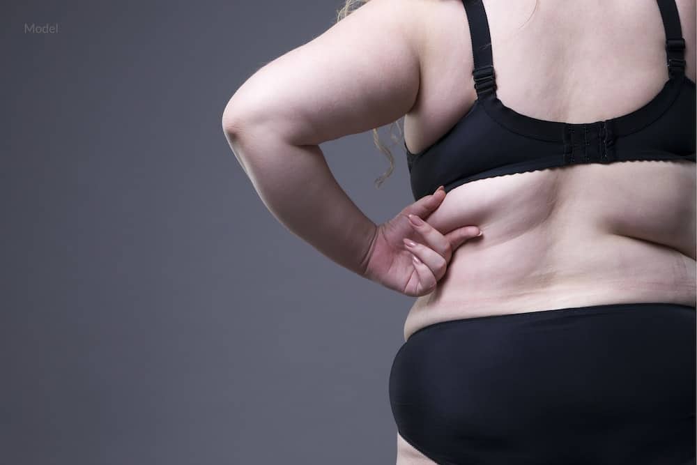 Woman grasping fat on her back that could benefit from bra fat removal surgery