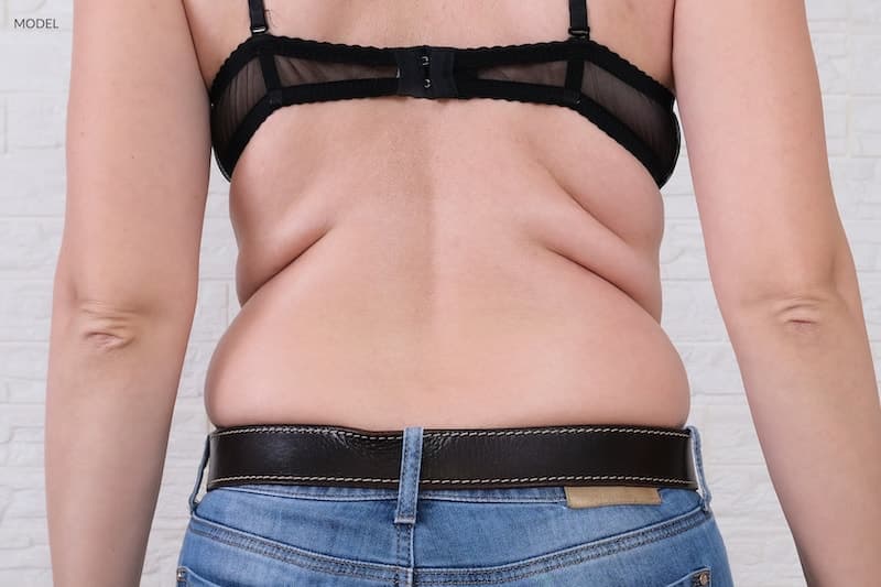 Bra Rolls Back Fat - Sadove Cosmetic Surgery