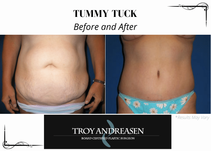 Before and after image showing the results of a tummy tuck performed in Ontario, CA.