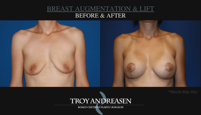 Before and after image showing the results of a breast augmentation and lift performed in Ontario, CA