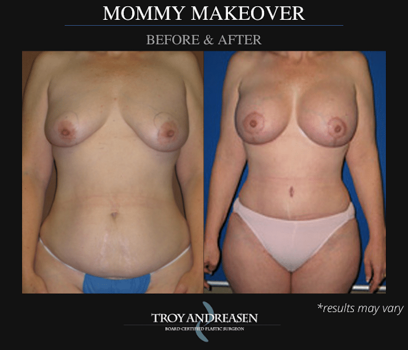 Before and after image showing the results of a Mommy Makeover performed in Ontario, CA.