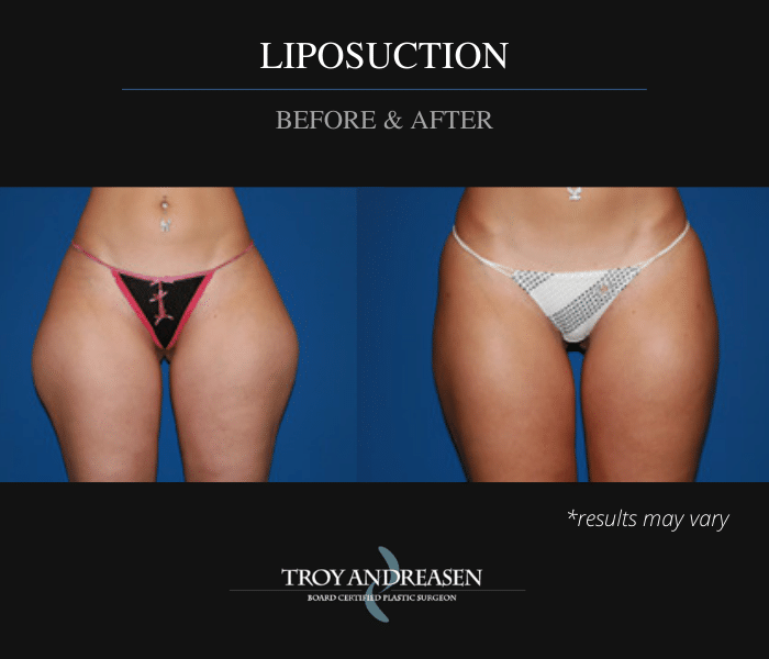 Before and after image showing the results of a liposuction treatment performed in Ontario, CA.