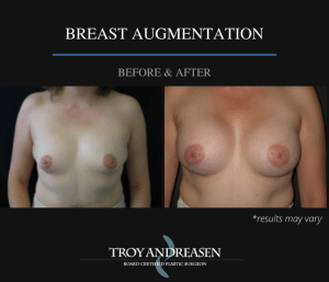 Before and after photo showing the results of a breast augmentation performed in the Inland Empire.