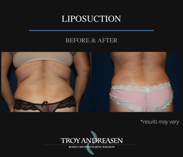 Before and after image showing the results of a liposuction performed in Ontario, California.