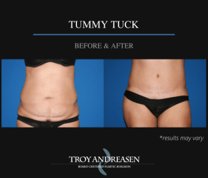 Before and after image showing the results of a tummy tuck performed in the Inland Empire, CA.
